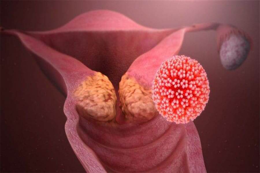 Illustrazione: utero infestato da parassiti